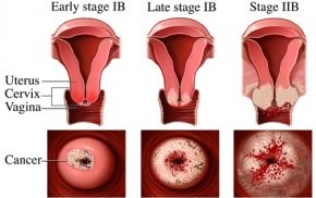 Cervical Cancer Stages