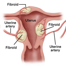 Uterine Fibroid